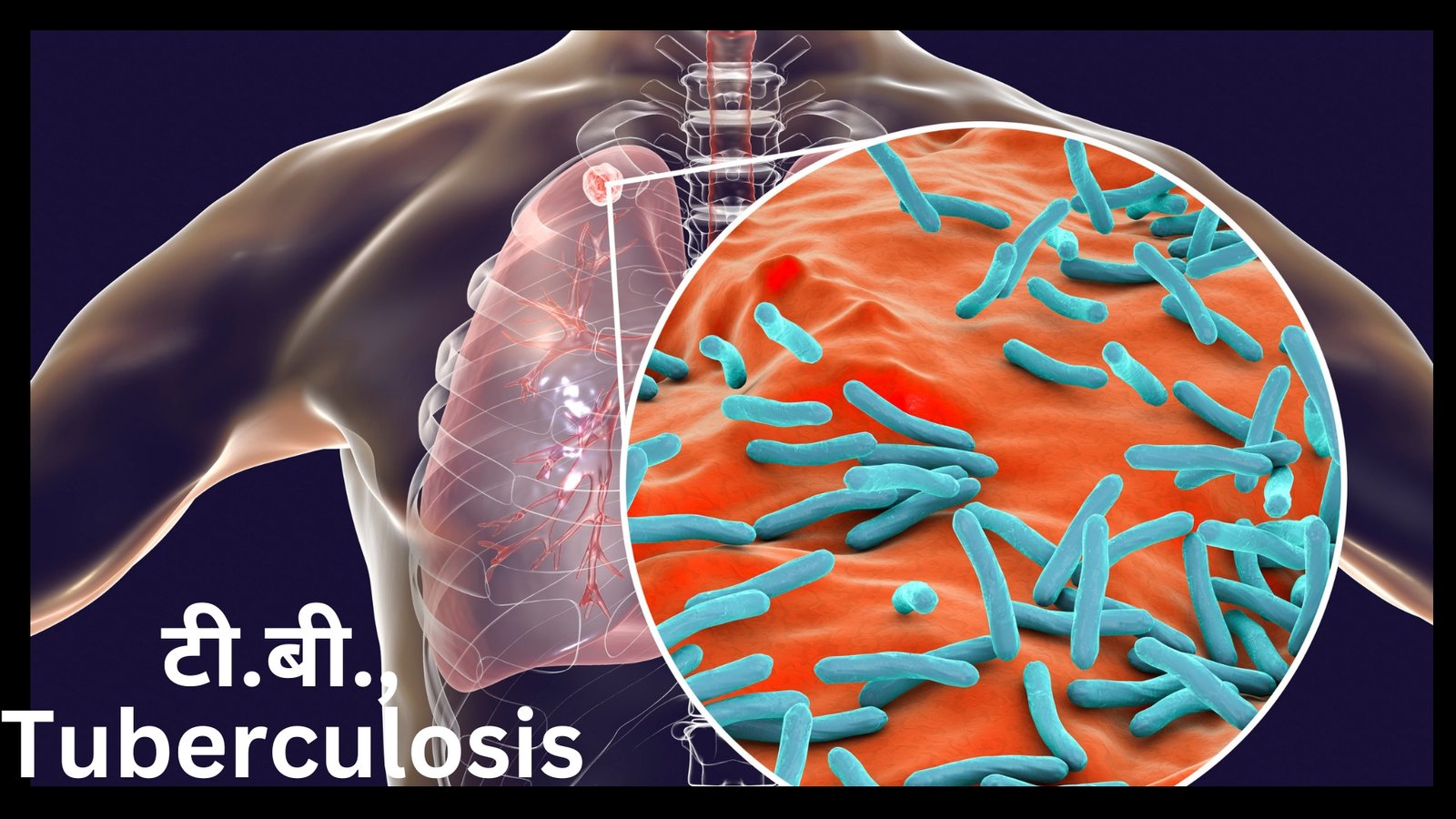 Tuberculosis Bacteria Illustration High-Res Vector Graphic - Getty Images